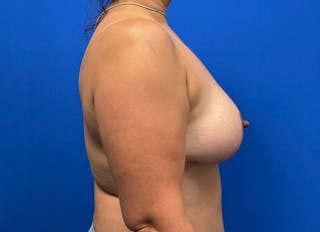 Flap Reconstruction Gallery Before & After Gallery - Patient 573884 - Image 10