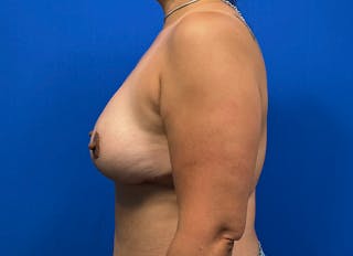 Flap Reconstruction Gallery Before & After Gallery - Patient 573884 - Image 2