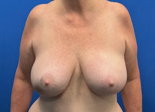Flap Reconstruction Gallery Before & After Gallery - Patient 307708 - Image 6