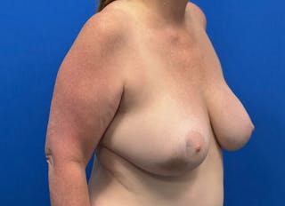 Flap Reconstruction Gallery Before & After Gallery - Patient 307708 - Image 8