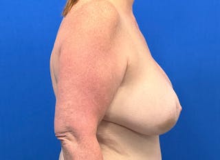 Flap Reconstruction Gallery Before & After Gallery - Patient 307708 - Image 10
