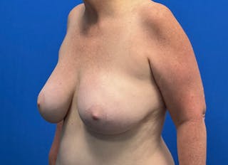 Flap Reconstruction Gallery Before & After Gallery - Patient 307708 - Image 4