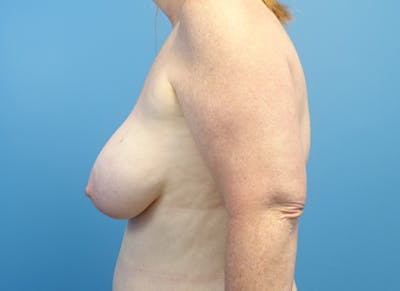 Flap Reconstruction Gallery Before & After Gallery - Patient 307708 - Image 1