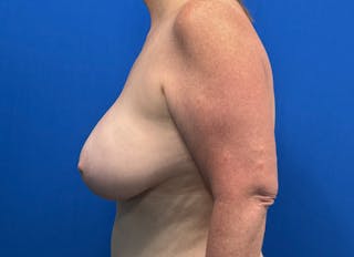 Flap Reconstruction Gallery Before & After Gallery - Patient 307708 - Image 2