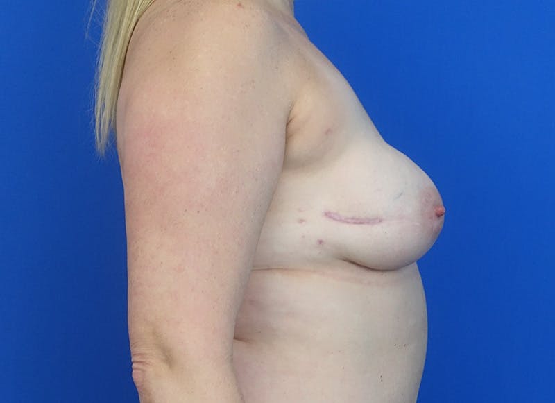 Flap Reconstruction Gallery Before & After Gallery - Patient 110890 - Image 9