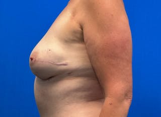 Flap Reconstruction Gallery Before & After Gallery - Patient 110890 - Image 2