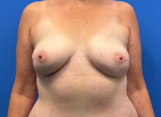 Flap Reconstruction Gallery Before & After Gallery - Patient 110890 - Image 6