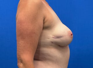 Flap Reconstruction Gallery Before & After Gallery - Patient 110890 - Image 10