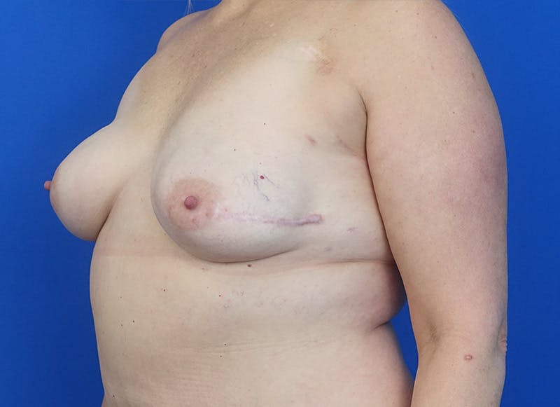 Flap Reconstruction Gallery Before & After Gallery - Patient 110890 - Image 3