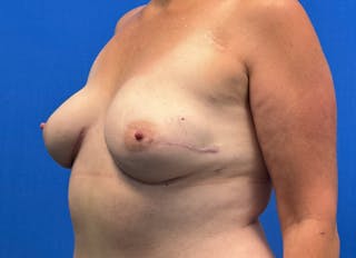 Flap Reconstruction Gallery Before & After Gallery - Patient 110890 - Image 4