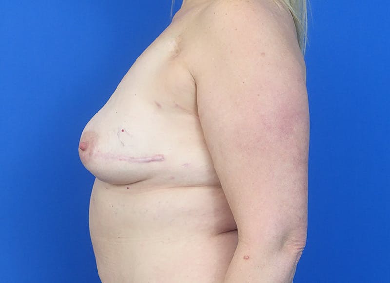 Flap Reconstruction Gallery Before & After Gallery - Patient 110890 - Image 1