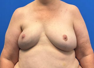 Flap Reconstruction Gallery Before & After Gallery - Patient 546310 - Image 6