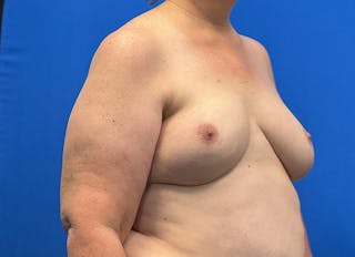Flap Reconstruction Gallery Before & After Gallery - Patient 546310 - Image 8