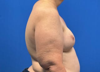 Flap Reconstruction Gallery Before & After Gallery - Patient 546310 - Image 10