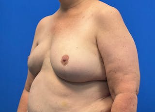 Flap Reconstruction Gallery Before & After Gallery - Patient 546310 - Image 4