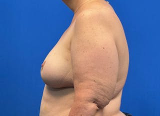 Flap Reconstruction Gallery Before & After Gallery - Patient 546310 - Image 2