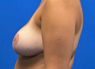 Breast Reduction Before & After Gallery - Patient 327996 - Image 2