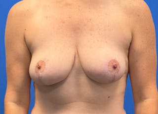 Breast Reduction Before & After Gallery - Patient 428034 - Image 6