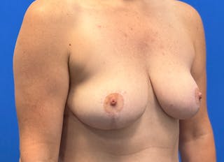 Breast Reduction Before & After Gallery - Patient 428034 - Image 8