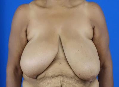 Breast Reduction Before & After Gallery - Patient 121727721 - Image 5