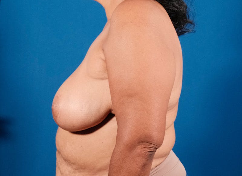 Breast Reduction Before & After Gallery - Patient 121727721 - Image 2