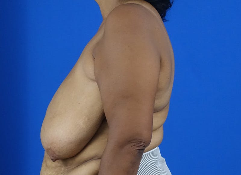 Breast Reduction Before & After Gallery - Patient 121727721 - Image 1