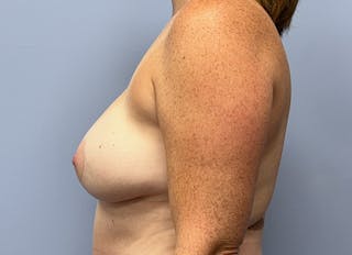 Hybrid Reconstruction Gallery Before & After Gallery - Patient 121143 - Image 2