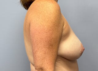 Hybrid Reconstruction Gallery Before & After Gallery - Patient 121143 - Image 10