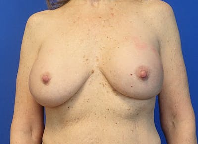 Implant Removal Before & After Gallery - Patient 324247 - Image 5