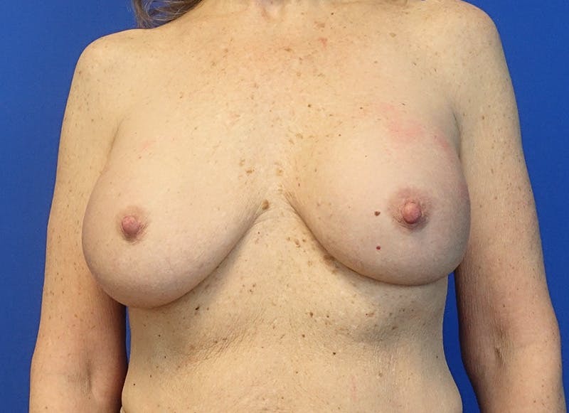 Implant Removal Before & After Gallery - Patient 324247 - Image 5
