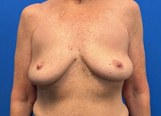 Implant Removal Before & After Gallery - Patient 324247 - Image 6