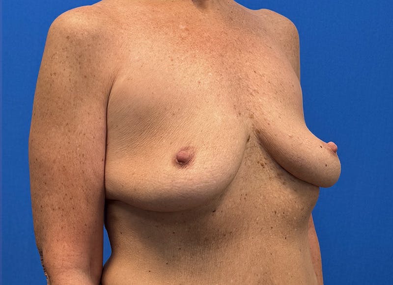 Implant Removal Before & After Gallery - Patient 324247 - Image 8