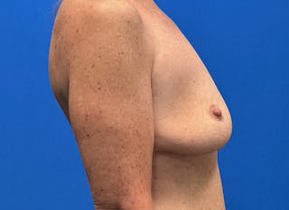 Implant Removal Before & After Gallery - Patient 324247 - Image 10