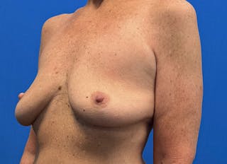 Implant Removal Before & After Gallery - Patient 324247 - Image 4