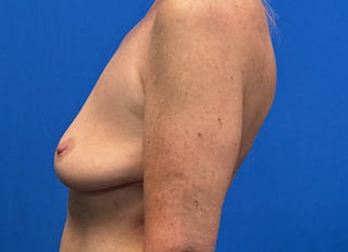 Implant Removal Before & After Gallery - Patient 324247 - Image 2