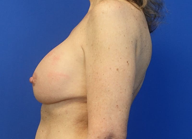 Implant Removal Before & After Gallery - Patient 324247 - Image 1