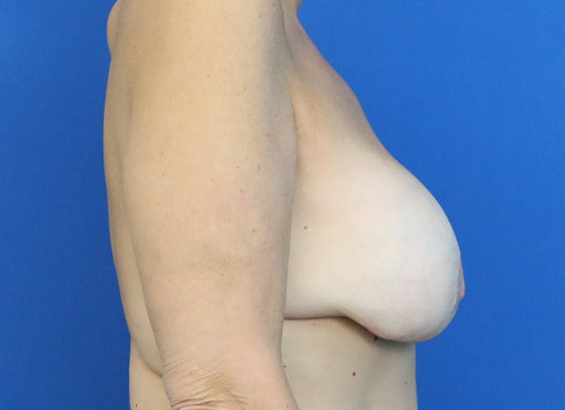 Implant Removal Before & After Gallery - Patient 124703 - Image 9