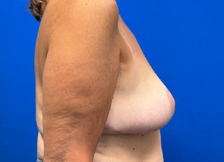 Implant Removal Before & After Gallery - Patient 124703 - Image 10