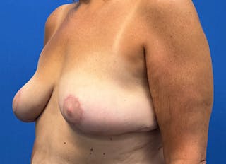 Implant Removal Before & After Gallery - Patient 124703 - Image 4