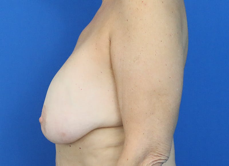 Implant Removal Before & After Gallery - Patient 124703 - Image 1