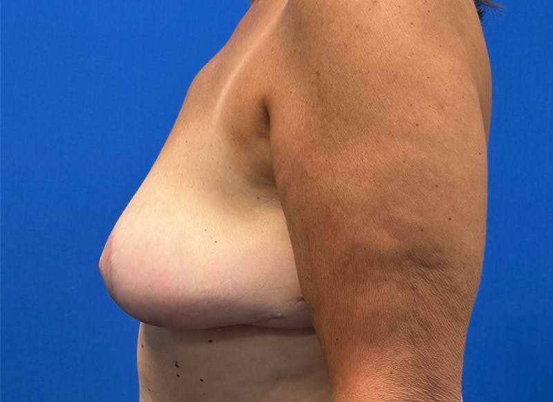 Implant Removal Before & After Gallery - Patient 124703 - Image 2