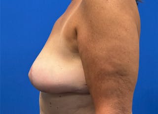 Implant Removal Before & After Gallery - Patient 124703 - Image 2