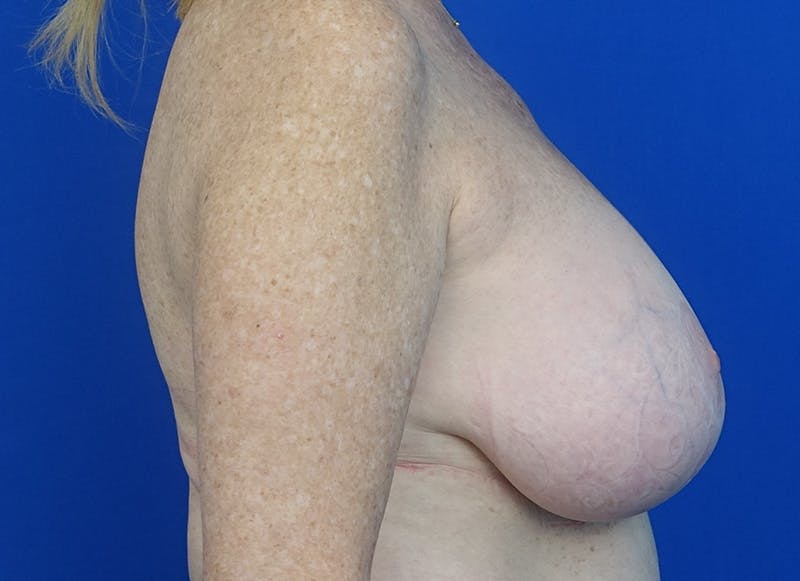 Implant Removal Before & After Gallery - Patient 121727273 - Image 9