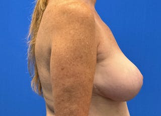 Implant Removal Before & After Gallery - Patient 121727273 - Image 10