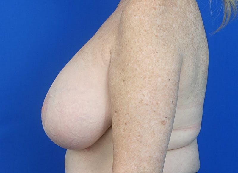 Implant Removal Before & After Gallery - Patient 121727273 - Image 1