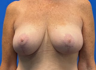 Implant Removal Before & After Gallery - Patient 121727273 - Image 6