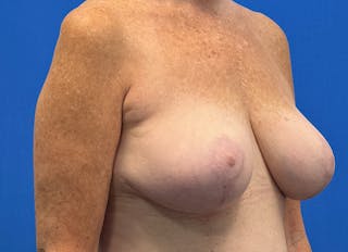 Implant Removal Before & After Gallery - Patient 121727273 - Image 8