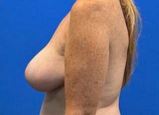 Implant Removal Before & After Gallery - Patient 121727273 - Image 2