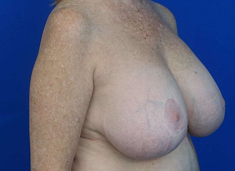 Implant Removal Before & After Gallery - Patient 121727273 - Image 7