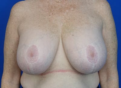 Implant Removal Before & After Gallery - Patient 121727273 - Image 5